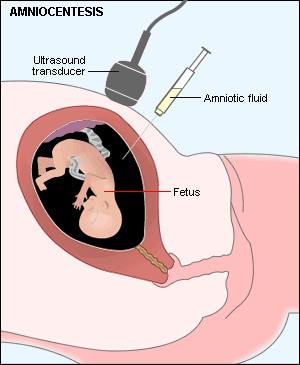 Prenatal testing: amniocentesis - Gyné