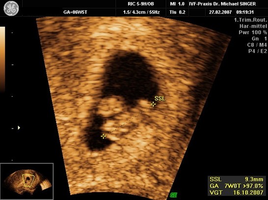 IVF-Schwangerschaft 10.Woche